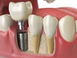trusted-dental-care-clinic-in-chetla-for-healthy-smile