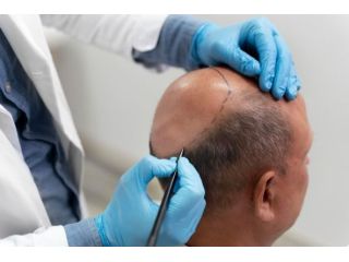 male-pattern-baldness-treatment-india-proven-hair-cure-small-0