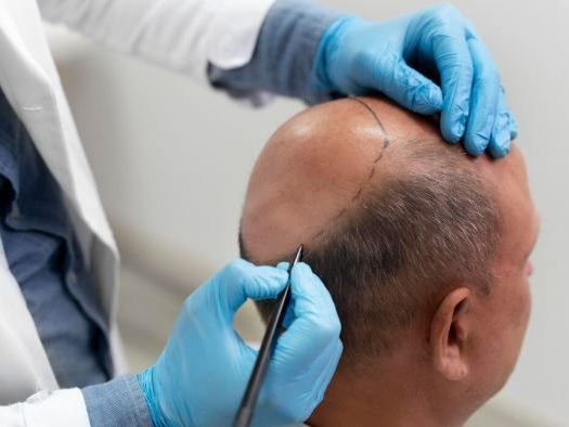 male-pattern-baldness-treatment-india-proven-hair-cure