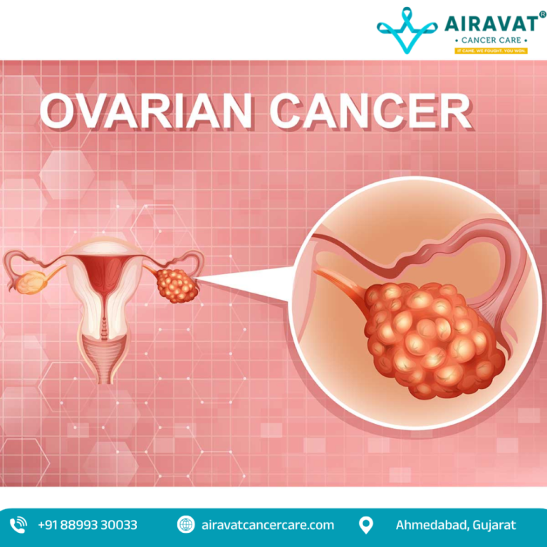 ovarian-cancer-treatment-in-ahmedabad-with-surgical-expertise-big-0