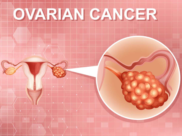 ovarian-cancer-treatment-in-ahmedabad-with-surgical-expertise