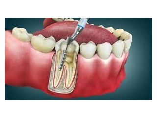 pain-free-root-canal-experts-in-chetla-small-0