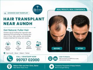 hair-transplant-near-aundh-small-0