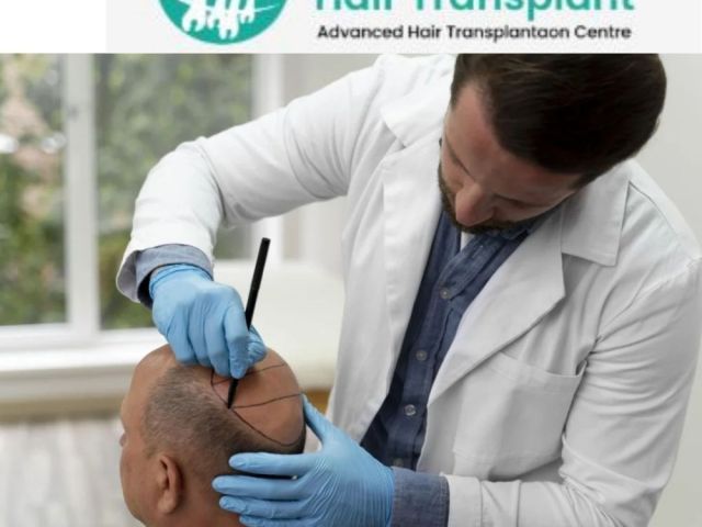 effective-hair-transplant-in-kondapur-for-natural-looking-results
