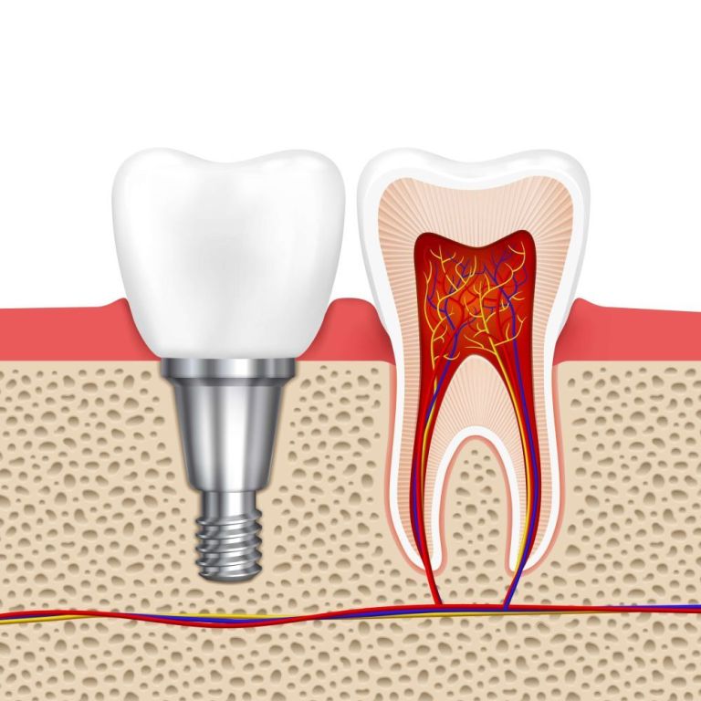 dental-implants-at-white-dental-healthcare-big-0