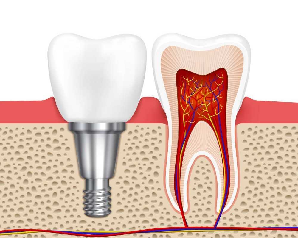 dental-implants-at-white-dental-healthcare