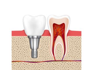 dental-implants-at-white-dental-healthcare-small-0