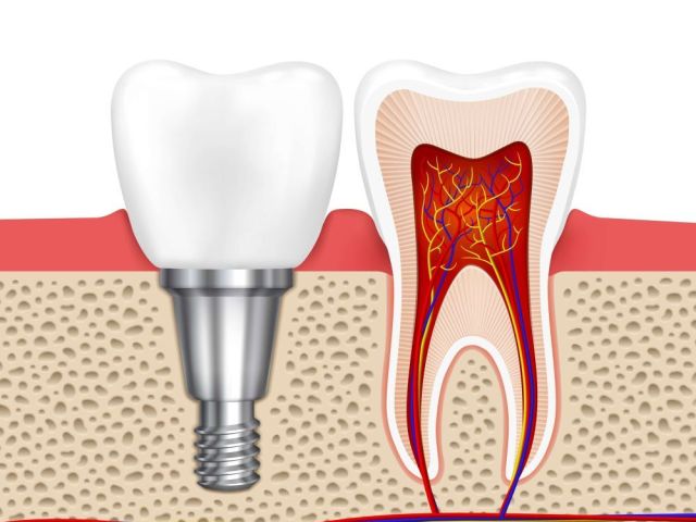 dental-implants-at-white-dental-healthcare