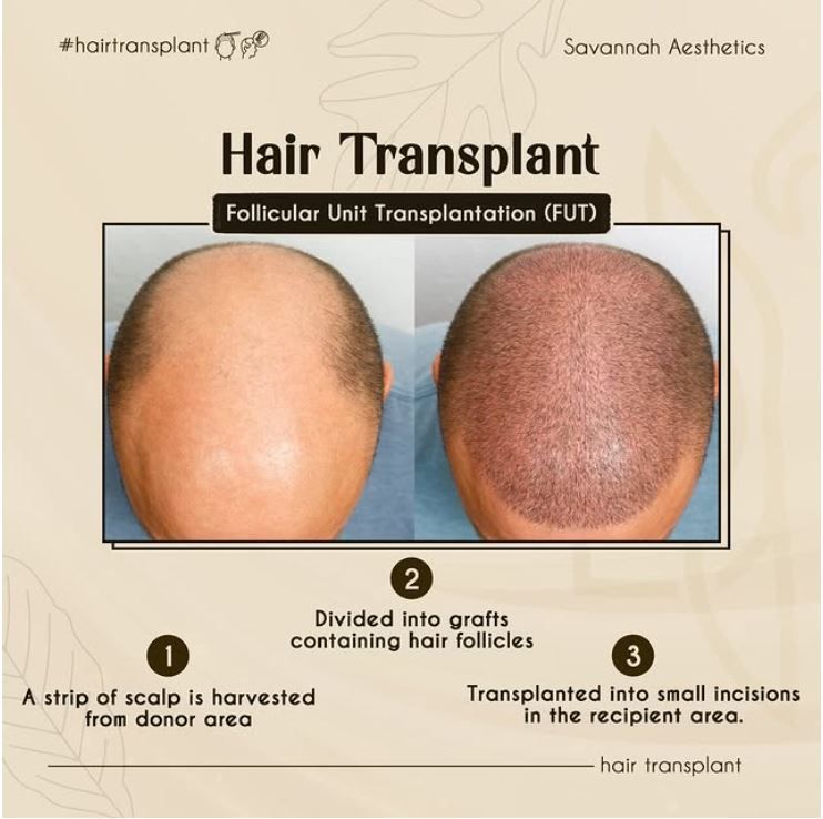 advanced-hair-gfc-treatment-ahmedabad-savannah-aesthetics-big-0