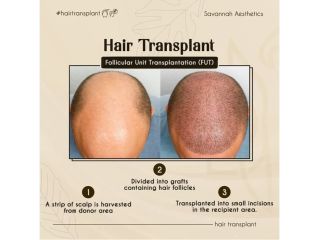 advanced-hair-gfc-treatment-ahmedabad-savannah-aesthetics-small-0