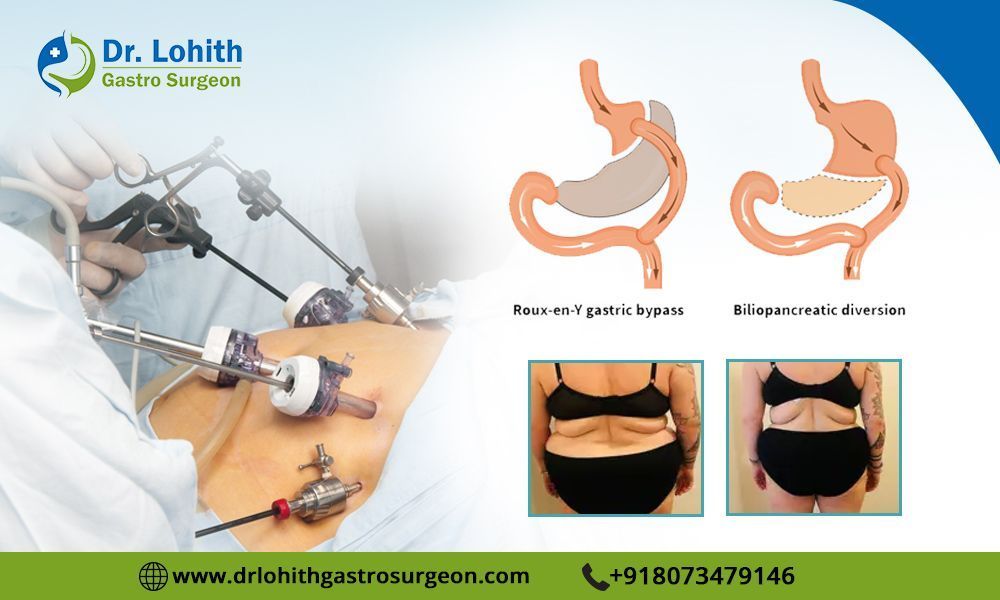 find-the-best-laparoscopic-bariatric-surgeon-in-bangalore-big-0