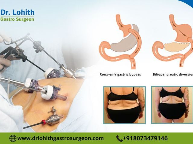 find-the-best-laparoscopic-bariatric-surgeon-in-bangalore