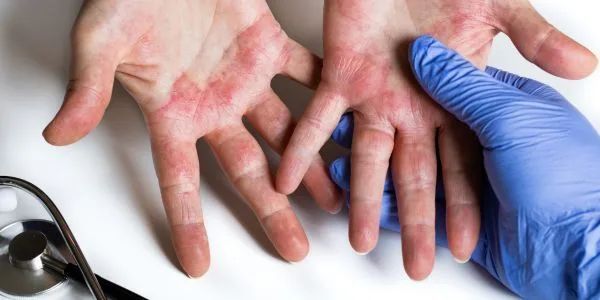 atopic-dermatitis-treatments-in-gurgaon-expert-care-big-0
