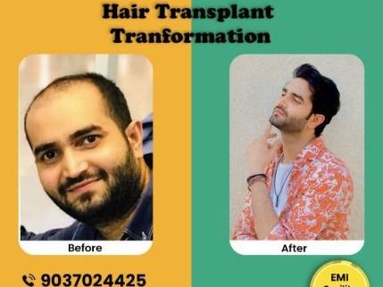 hair-tree-clinic-expert-hair-transplant-prp-in-kerala