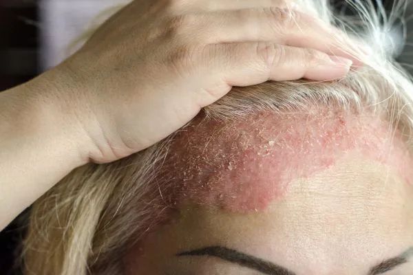 eczema-rash-treatment-in-gurgaon-skin-experts-big-1