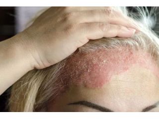 eczema-rash-treatment-in-gurgaon-skin-experts-small-0
