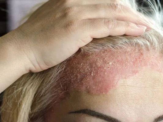 eczema-rash-treatment-in-gurgaon-skin-experts