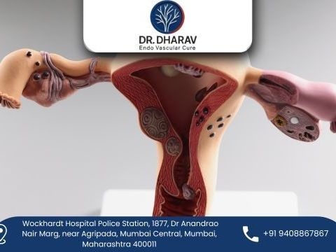 effective-uterine-fibroids-treatment-by-dr-dharav-kheradia