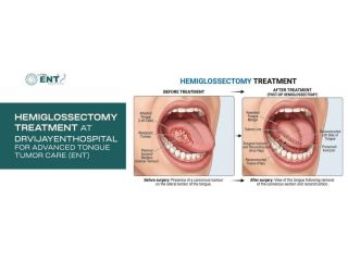 hemiglossectomy-treatment-at-drvijayenthospital-small-0