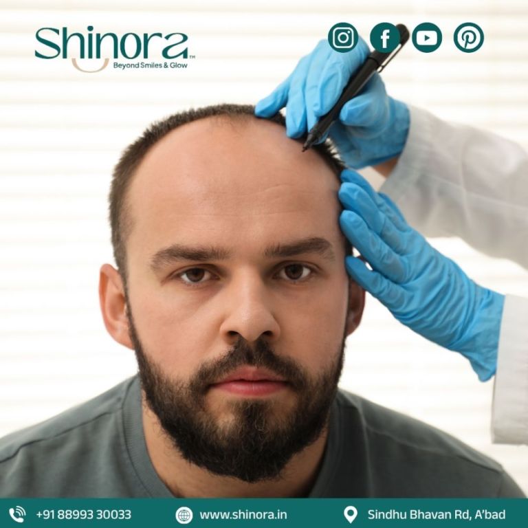 natural-results-with-hair-transplant-in-ahmedabad-big-0