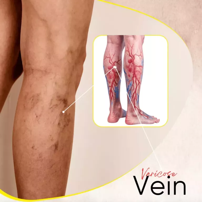 best-varicose-veins-treatment-in-lucknow-safe-advanced-care-big-0