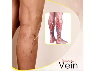 best-varicose-veins-treatment-in-lucknow-safe-advanced-care-small-0