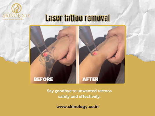 best-tattoo-removal-treatment-in-indore-for-clear-skin