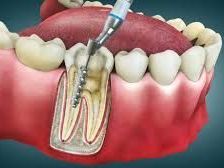 pain-free-root-canal-experts-in-chetla