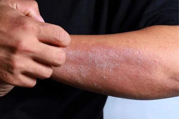 best-dermatologist-for-eczema-treatment-gurgaon-big-0