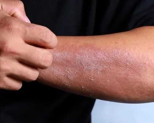 best-dermatologist-for-eczema-treatment-gurgaon