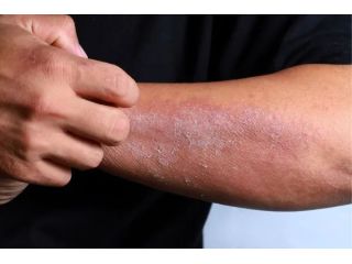 best-dermatologist-for-eczema-treatment-gurgaon-small-0