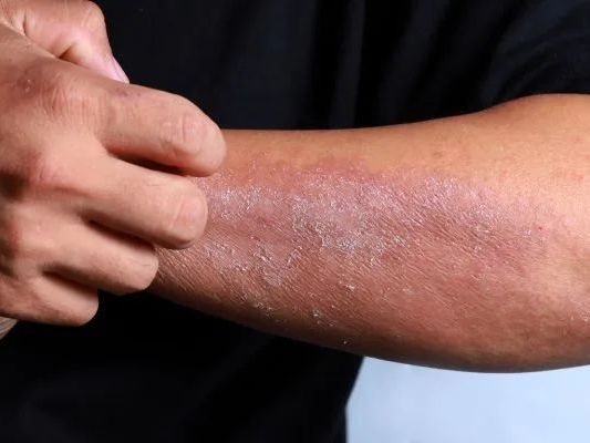 best-dermatologist-for-eczema-treatment-gurgaon