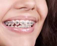 get-perfect-smile-with-dental-braces-in-chetla-today