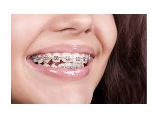 get-perfect-smile-with-dental-braces-in-chetla-today-small-0