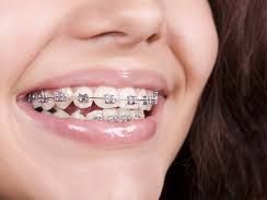 get-perfect-smile-with-dental-braces-in-chetla-today
