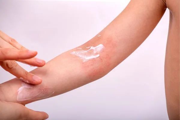 allergic-dermatitis-treatment-in-gurgaon-expert-care-big-0