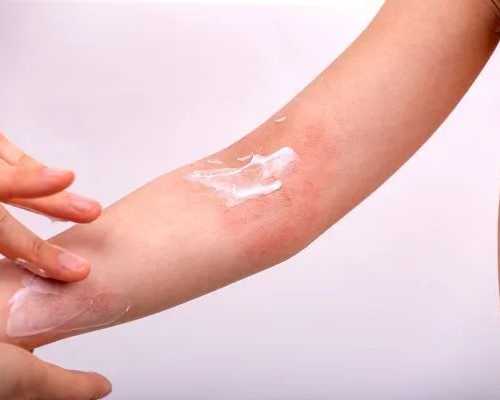 allergic-dermatitis-treatment-in-gurgaon-expert-care