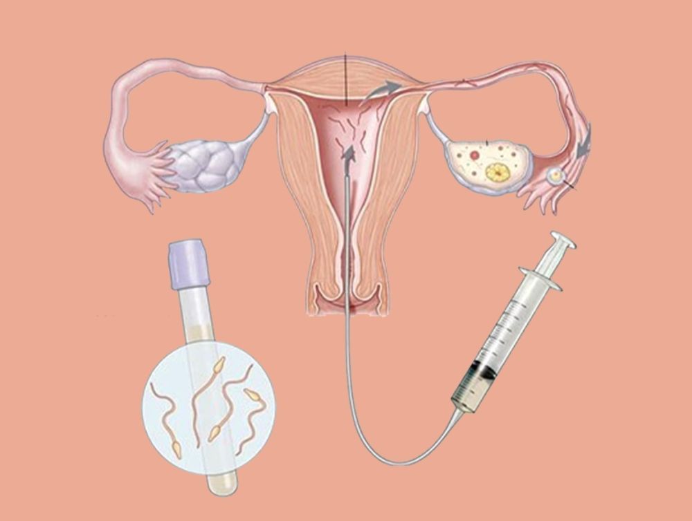 best-iui-clinic-in-kalkaji-south-delhi-for-fertility-care-big-0