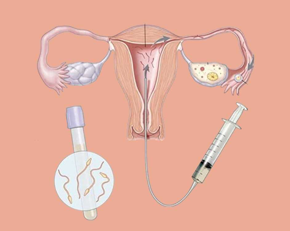 best-iui-clinic-in-kalkaji-south-delhi-for-fertility-care