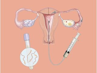best-iui-clinic-in-kalkaji-south-delhi-for-fertility-care-small-0