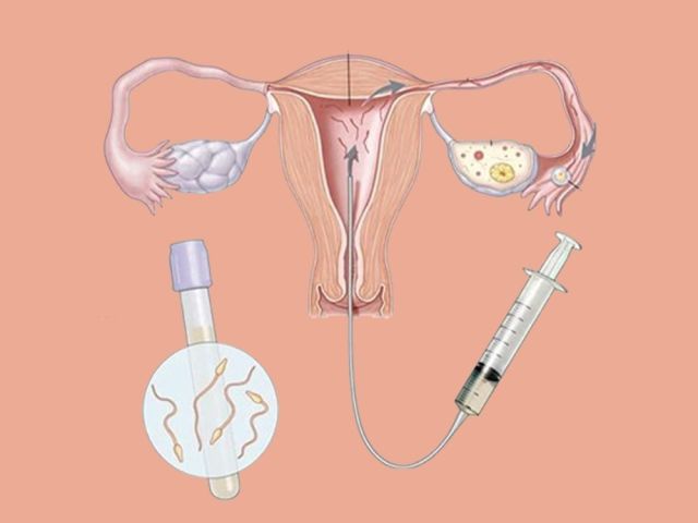 best-iui-clinic-in-kalkaji-south-delhi-for-fertility-care