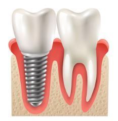 dental-implant-treatment-in-silchar-advanced-care-big-0