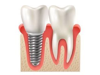 dental-implant-treatment-in-silchar-advanced-care-small-0