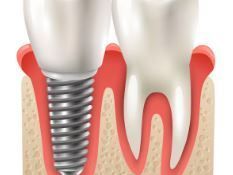 dental-implant-treatment-in-silchar-advanced-care