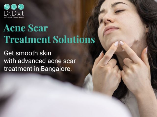 professional-acne-scar-removal-services-in-bangalore