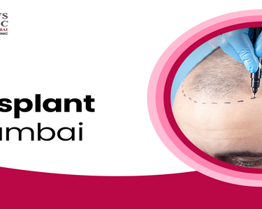 advanced-hair-transplant-in-mumbai-by-expert-surgeons