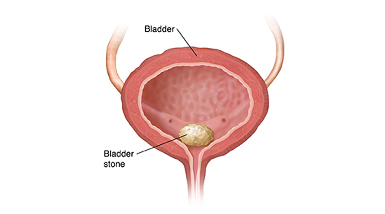 best-hospital-for-bladder-control-problems-big-0