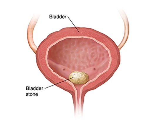 best-hospital-for-bladder-control-problems