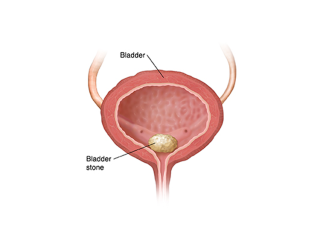best-hospital-for-bladder-control-problems-small-0