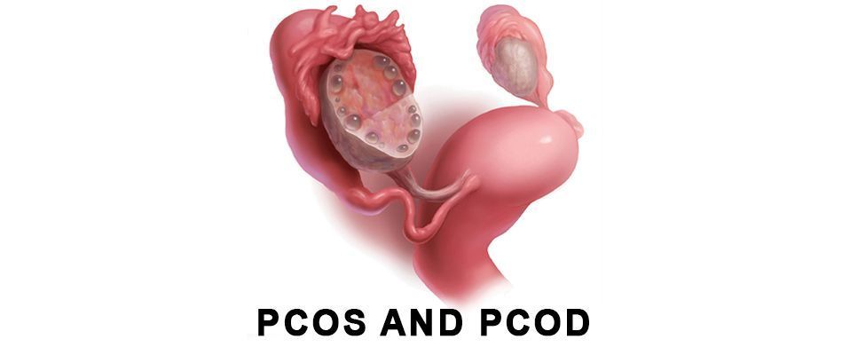 best-hospital-for-pcod-and-pcos-treatment-big-0